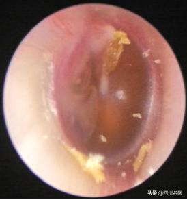 耳闷肯定是中耳炎吗,耳堵耳闷医生说不要管