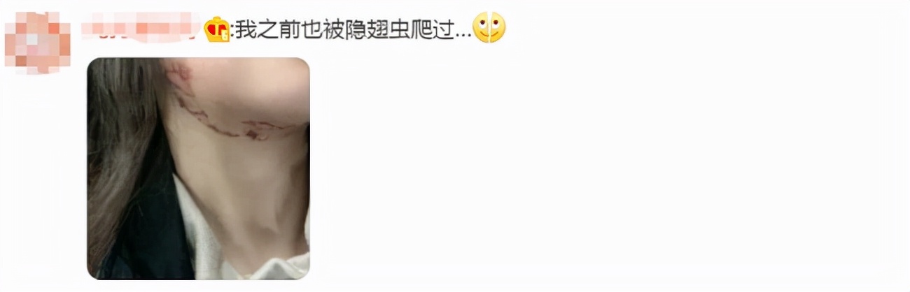 40岁女人脸被隐翅虫烧伤毁容吗,隐翅虫碰到脸上了是不是会毁容