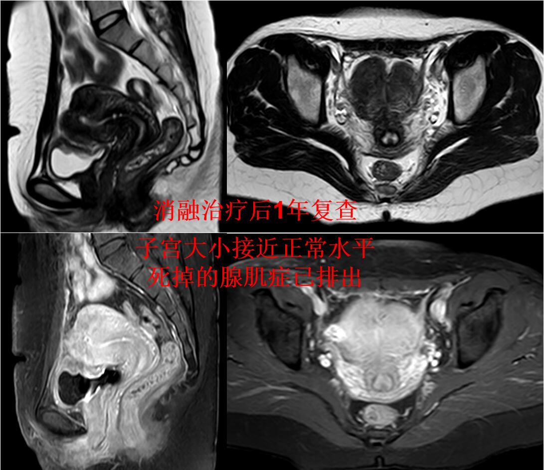 看看痛不欲生的子宫腺肌症痛经专业领域的看法与典型病例