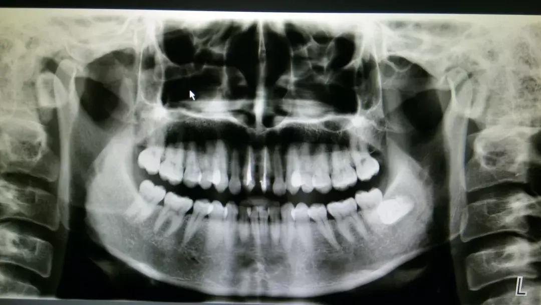那些不拔智齿的人后来都怎么样了,那些该拔不拔的智齿最后都咋样了
