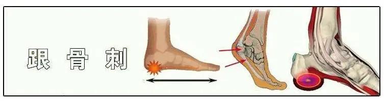 跟骨骨折和足跟骨刺哪个严重,足跟骨刺走路疼痛该如何治疗