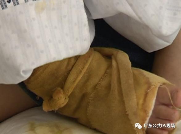 剧毒毒蛇咬伤小孩,要是毒蛇把孩子咬到了怎么处理