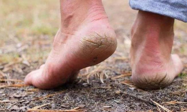 脚后跟和脚丫干裂药膏推荐,脚后跟干裂脚丫烂掉