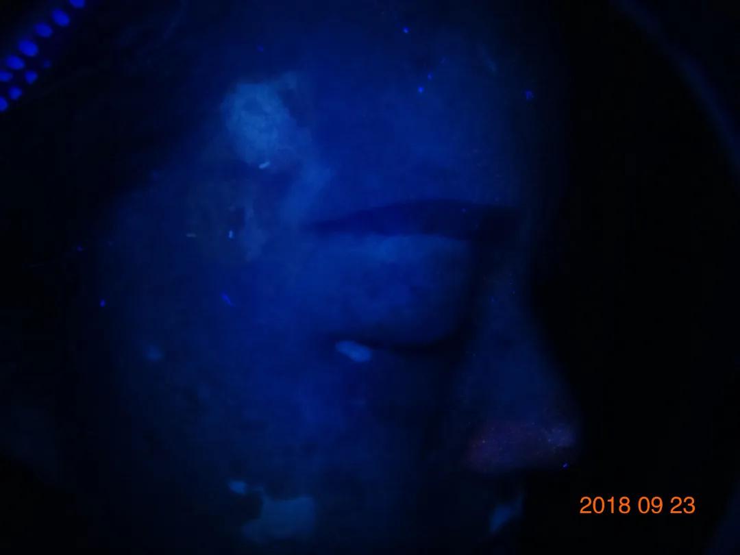 白癜风治愈一百例,白癜风治愈患者分享痊愈经验