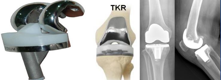膝关节骨性关节炎症状及治疗,膝关节骨性关节炎诊疗指南下载