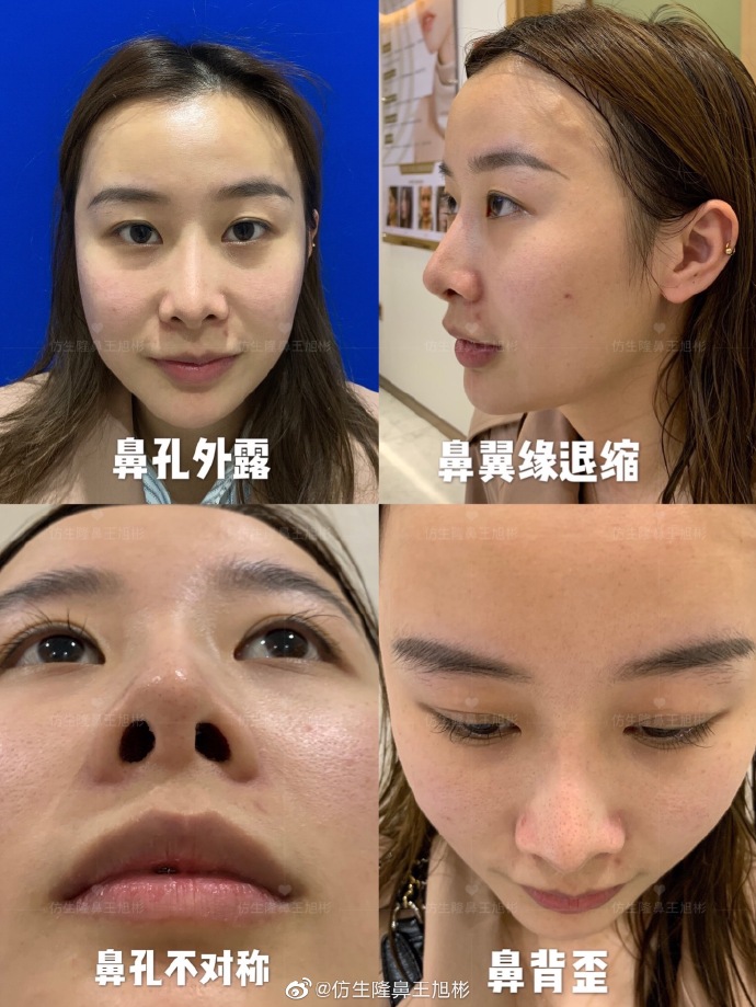 假体隆鼻耳软骨垫鼻尖图片,l型假体耳软骨隆鼻图片