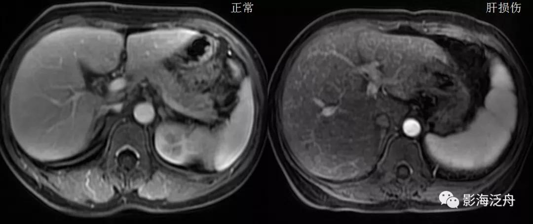 肝脏弥漫性病变严重吗,肝脏弥漫性的病变的症状