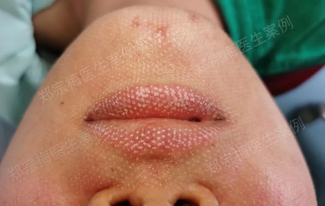 fotona4d有效果吗,fotona4d做完前后对比