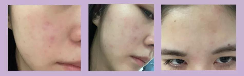 抗炎痘痘,痘痘肌抗炎产品