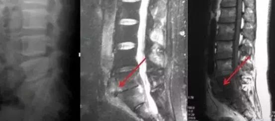 脊柱结核保守治疗大约需要多少钱,脊柱结核可以保守治疗