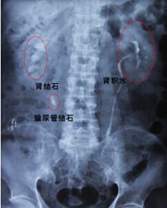 输尿管结石没有血尿结石能排出么,得了尿结石输尿管结石0.6严重吗