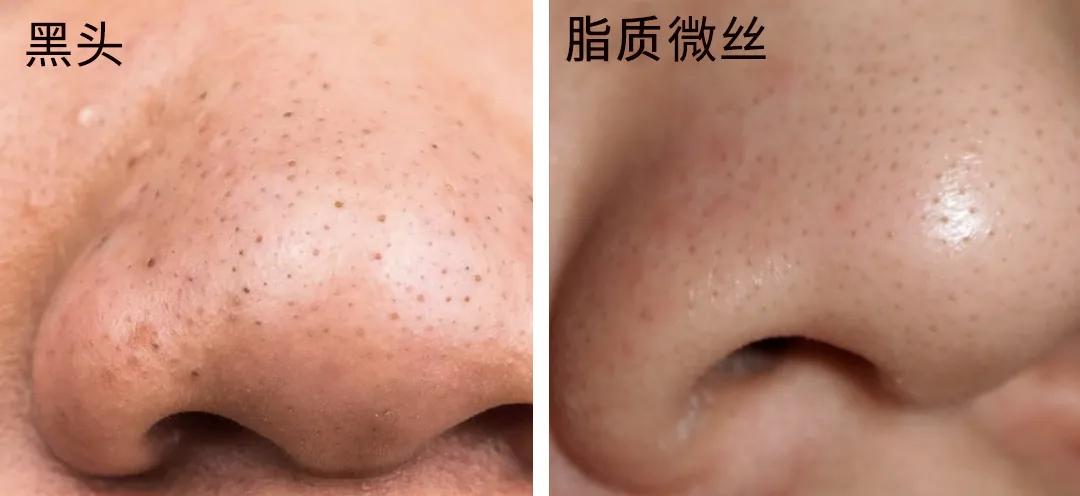 去除黑头最简单最有效的方法,去除黑头既简单又有效的方法