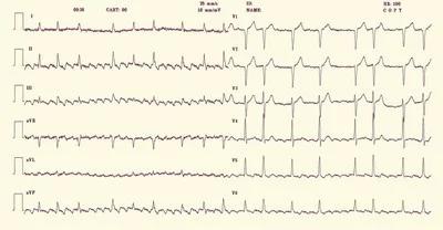 心肌缺血引起心绞痛怎么办,心肌缺血引起的心绞痛怎么治疗