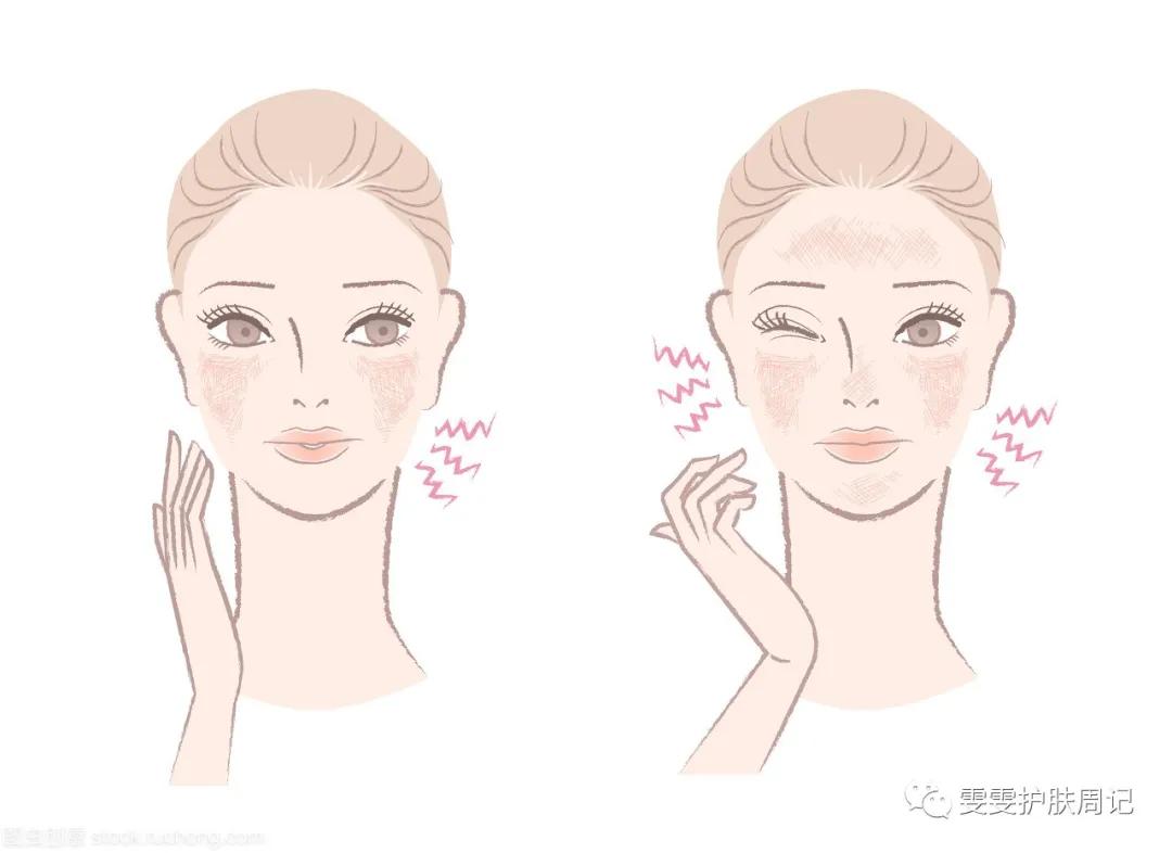 雯雯护肤小课堂：谁做过激光祛痘？