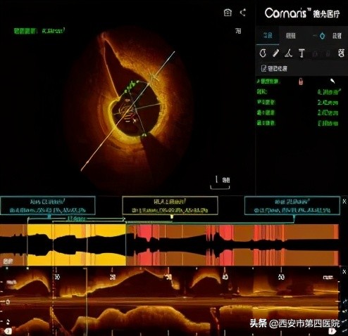 我院完成首例冠脉介入治疗,你是我的眼睛医院