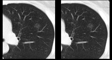 华西廖正银教授治肺结节,华西医院肺癌专家唐小军