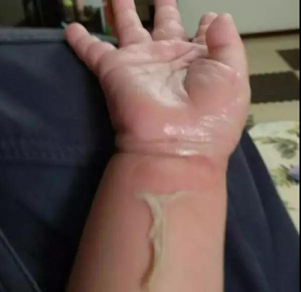 4岁女孩被油烫伤，爷爷的处理方式太赞了，医生都竖起了大拇指