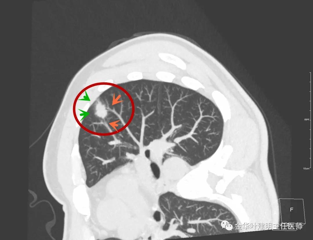 叶建明谈肺结节:一招分辨隐球菌性肉芽肿与肺癌