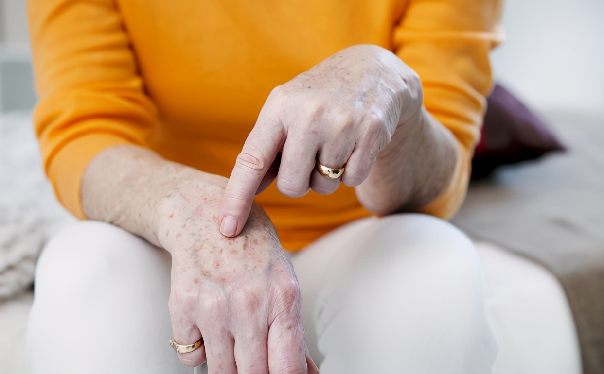 身上长了“老年斑”，有办法淡化或彻底去除吗？医生：有4种方法