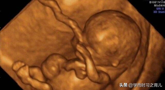 胎儿做四维照不到脸怎么办,四维彩超胎儿害羞捂脸不给看