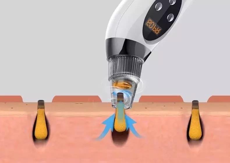 去黑头的最佳时间和方法,去黑头的时间段