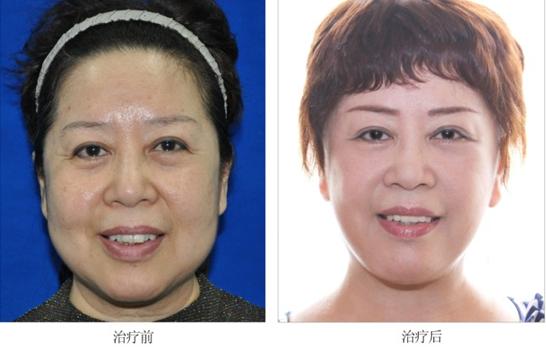 小拉皮的手术容易留疤吗,小拉皮手术的切口为什么在耳前