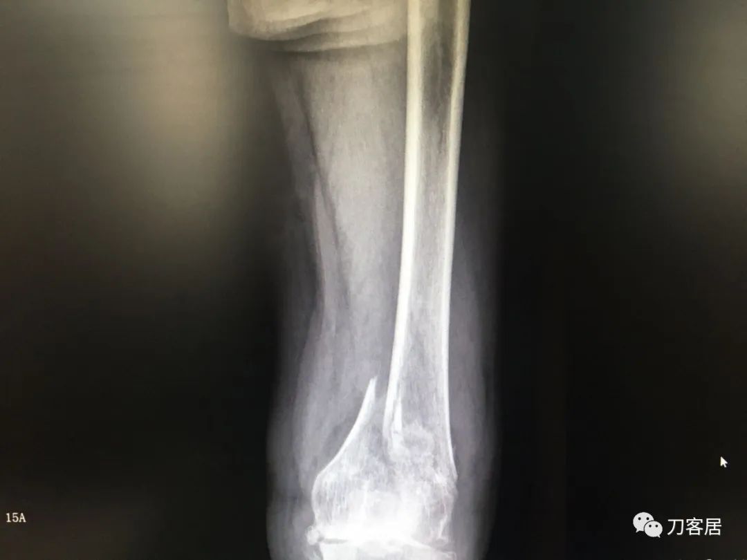 股骨胫骨骨折中医治疗方法,中药治疗股骨颈骨折