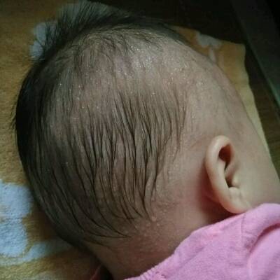 婴儿为什么爱长痱子,宝宝老爱出汗长痱子原因