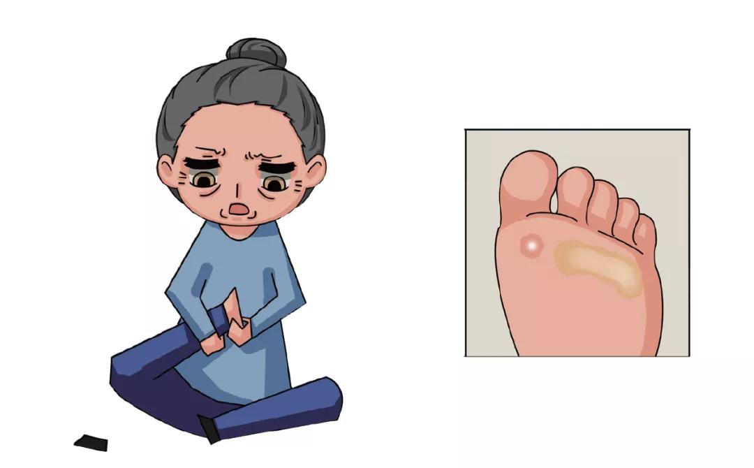 脚底经常长鸡眼和老茧是怎么回事,鸡眼和老茧别再傻傻分不清