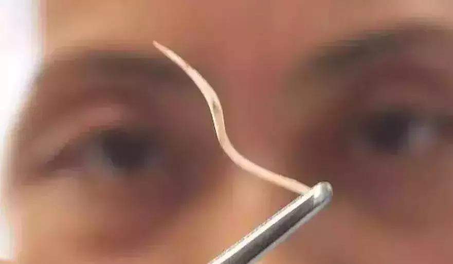 卡鱼刺在喉咙吃醋有用吗,吃鱼刺卡到的急救方法