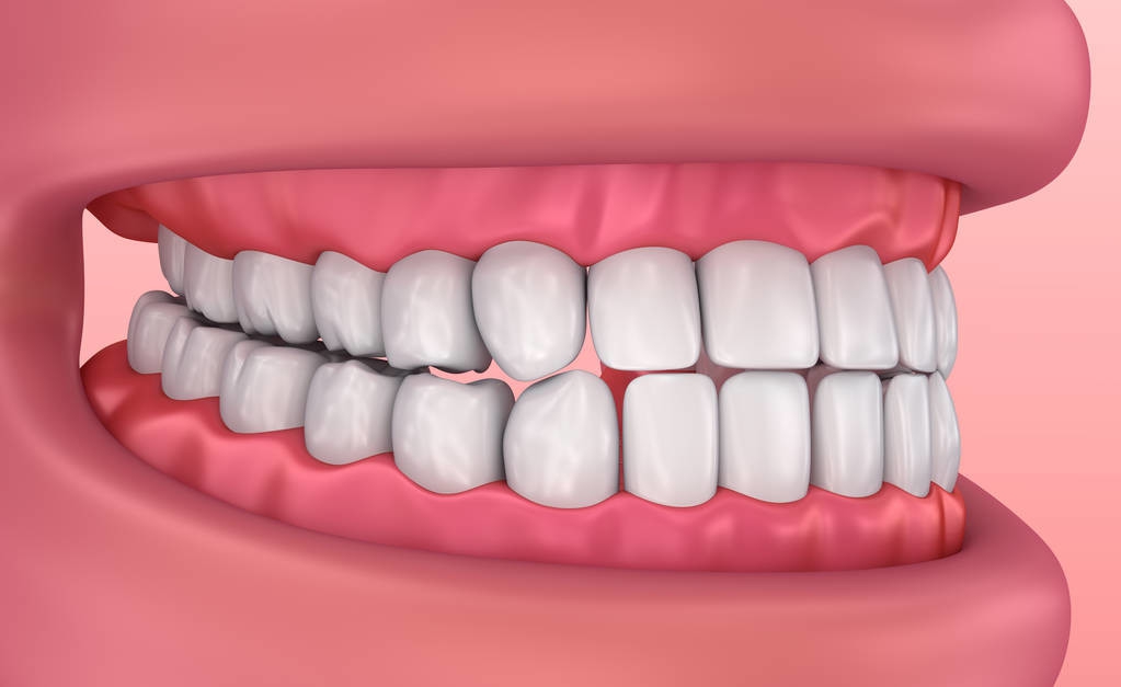 掉了三颗牙能做烤瓷牙吗,被牙医坑做烤瓷牙