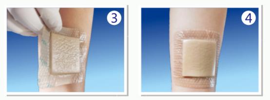 手术伤口愈合后怎么护理好得快,怎么护理伤口的视频