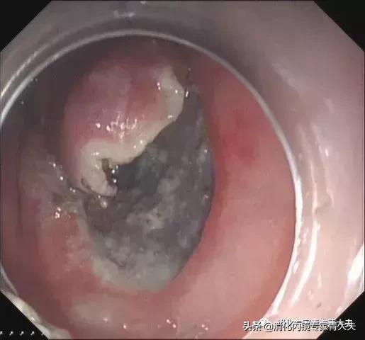 关于胃原位癌的科普文章,消化道早癌科普文章