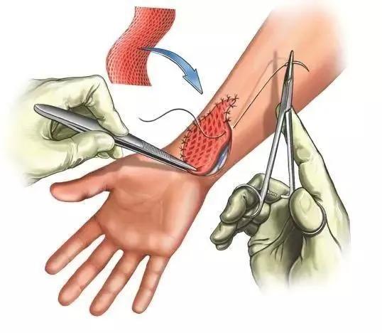 烫伤后及时清创能促进伤口愈合吗,深度烫伤后多久植皮比较好