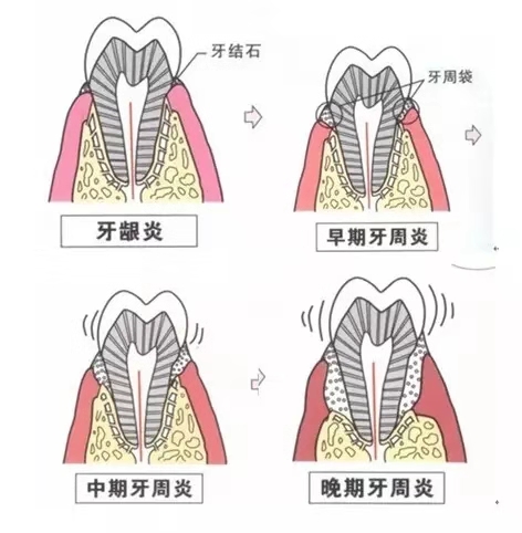 牙周太差怎么矫正,牙周不好怎么矫正牙齿