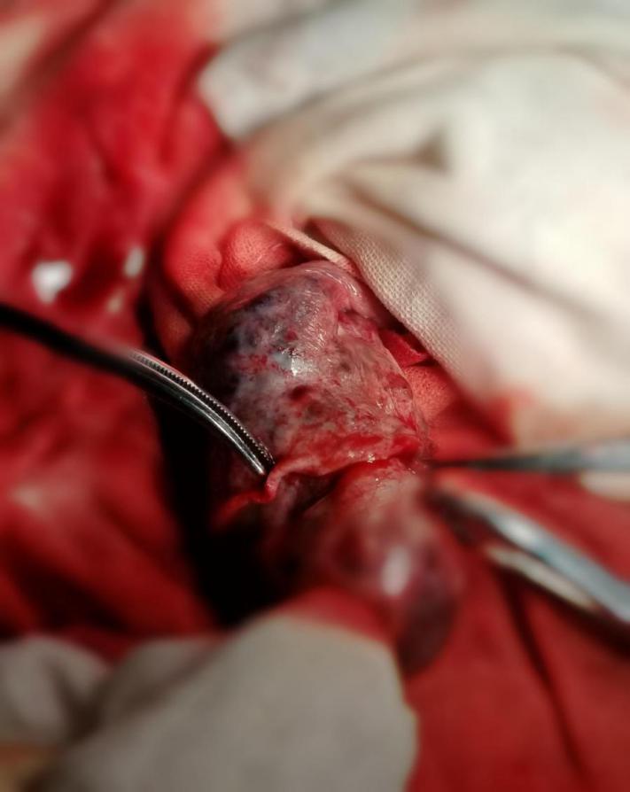 孕晚期突发腹痛:当心卵巢肿瘤扭转