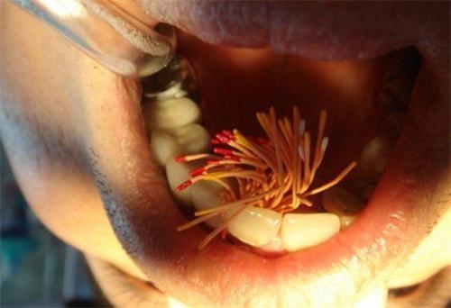 根管治疗第四步骤,根管治疗案例分享话术