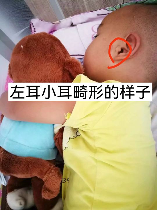 小耳畸形再造手术有后遗症吗,儿童小耳畸形去哪里做手术好