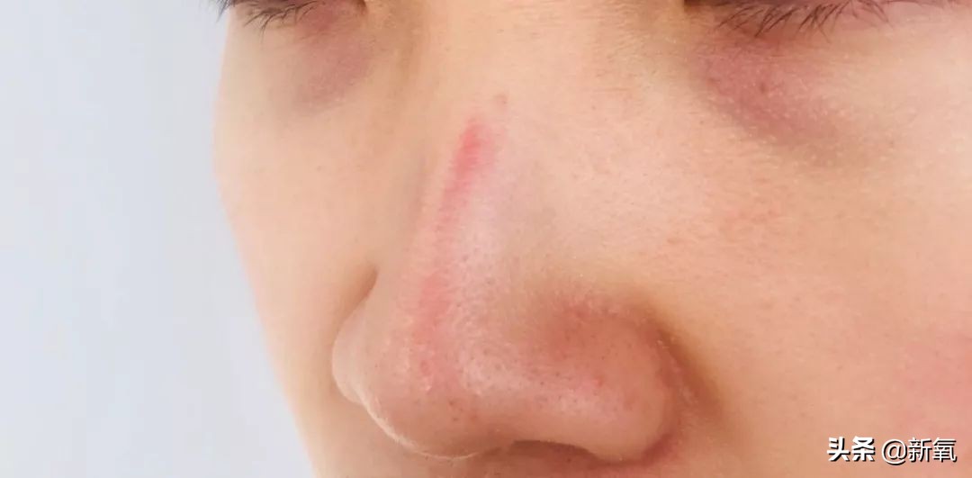 戴口罩久了皮肤屏障会受损吗,戴口罩戴久了鼻子不舒服