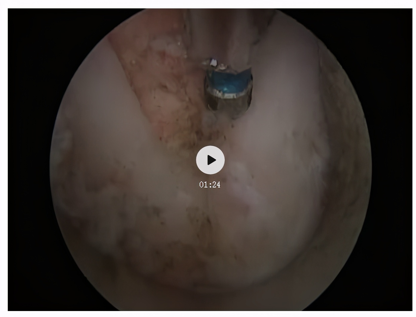 脊椎压迫神经做了微创术后腿麻疼,神经根损伤疼痛治疗