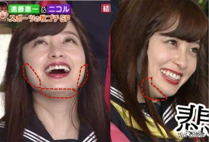 迷死氧亲身体验，我在日本吸掉了一桶脂肪和半张脸