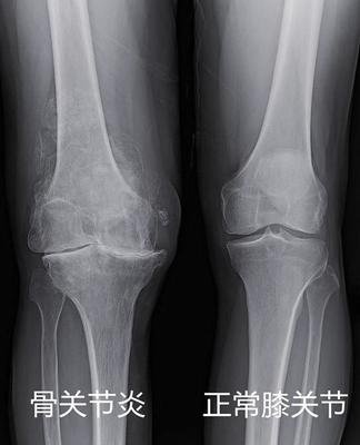 膝盖关节炎骨刺用什么药缓解疼痛,受冷膝盖长骨刺能治好吗