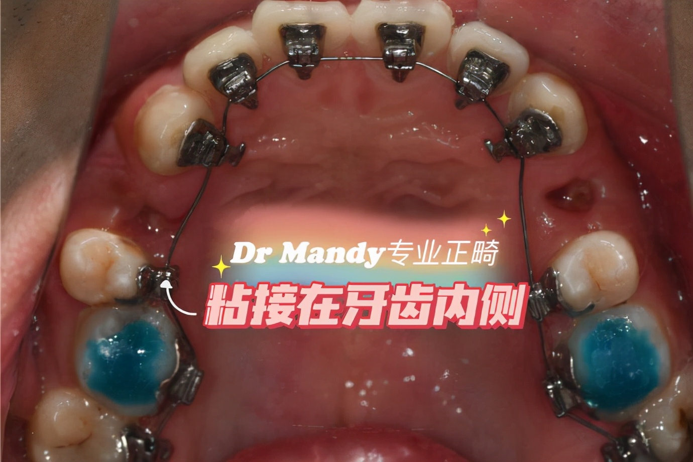 杭州如何选择牙齿矫正,杭州牙齿矫正哪个医生好