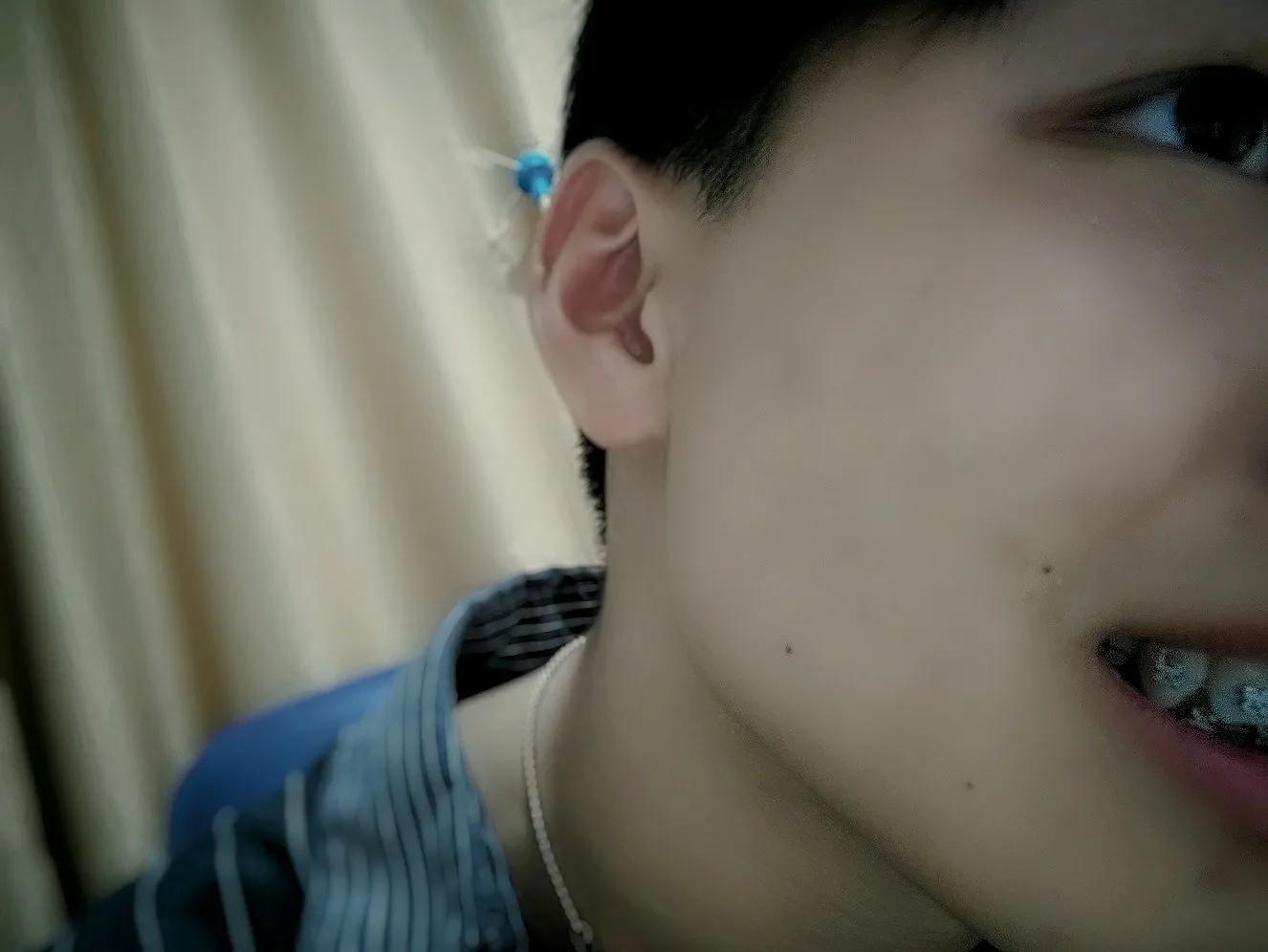 戴了牙套会更好看吗,戴了牙套有后遗症吗