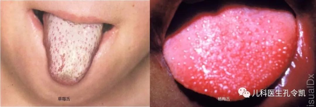 发热出红疹子可以吃过敏药吗,发热皮疹会反复么