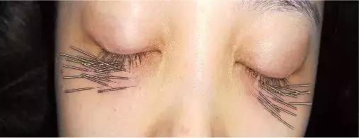 消除黑眼圈的有效日常方法,消除黑眼圈请看这里