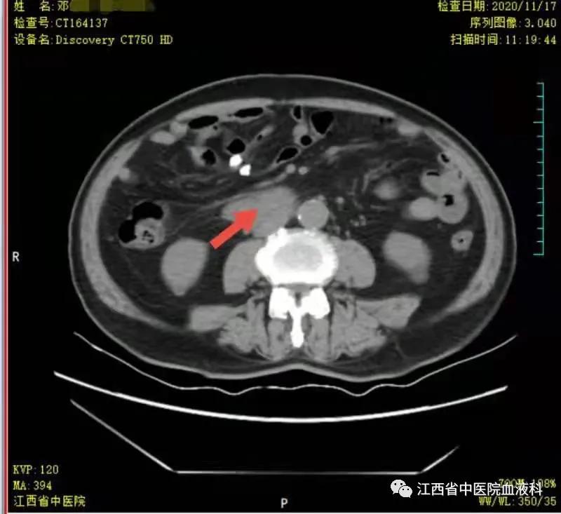 老年血液病患者的护理要点,老人血液病怎么补血