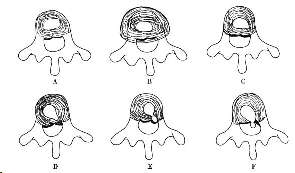什么是腰椎间盘膨出？很严重吗？