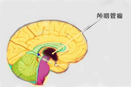 颅咽管瘤二次手术真实治愈率,颅咽管瘤不手术不治疗有什么危险