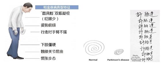 帕金森病不仅仅是手抖这么简单,帕金森病并非手抖那么简单